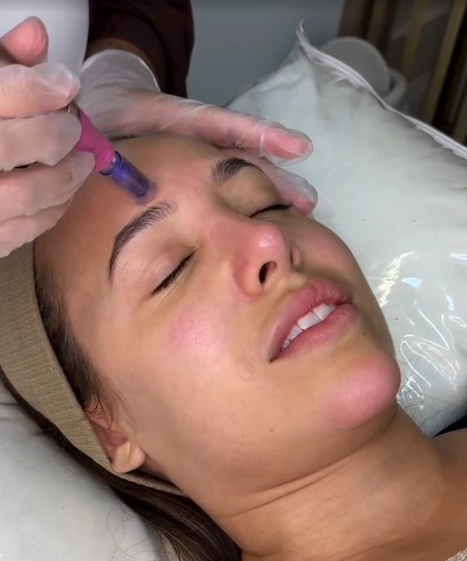 Microagulhamento Facial