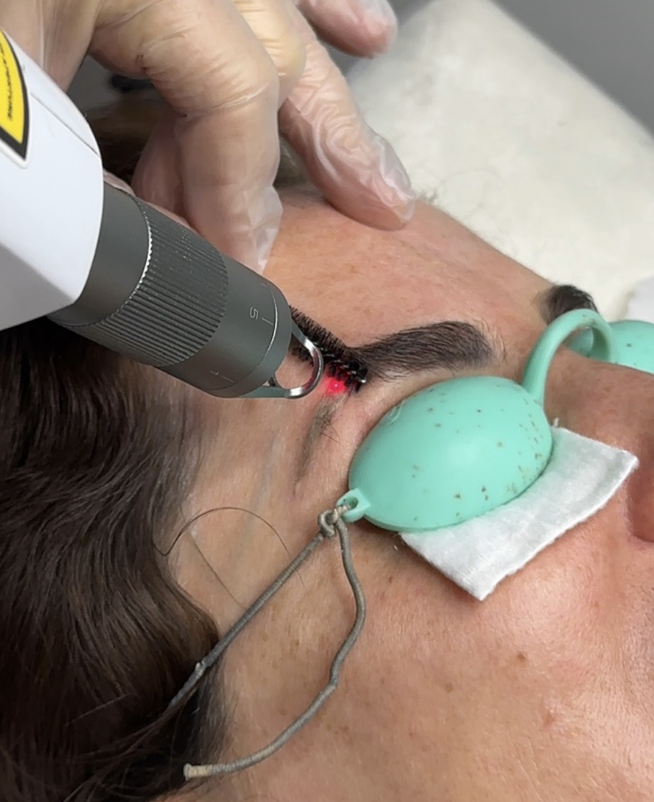 Remoção de Micropigmentação